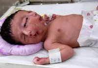 Pakistan'da İki Yüzlü Bebek Doğdu!
