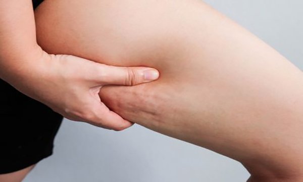 Kadınlarda sık görülen Lipödem’e (Ağrılı Selülit) dikkat